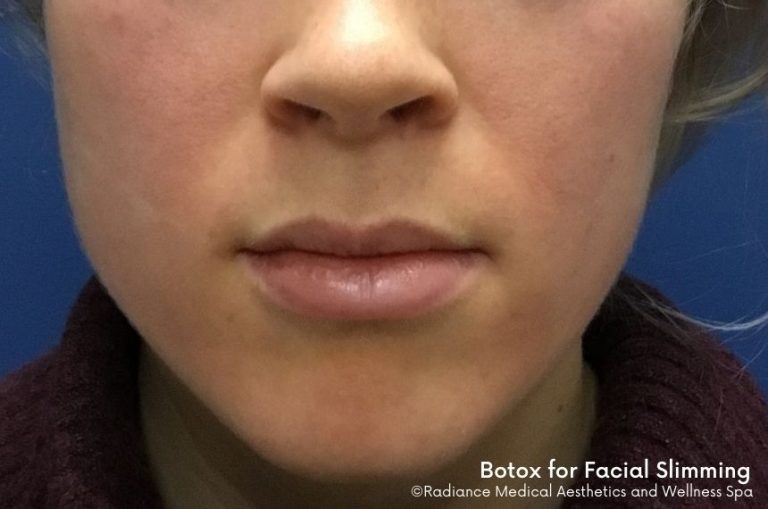 before image of face for jaw botox