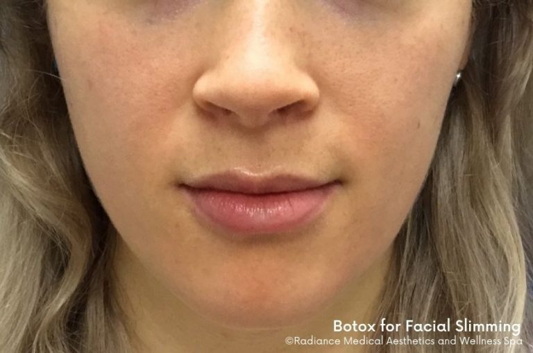 after photo of patient who had botox in jaw