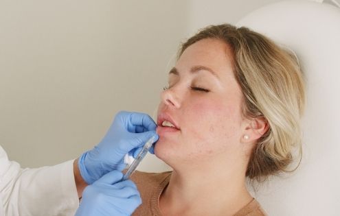 woman getting lip filler injected into lips