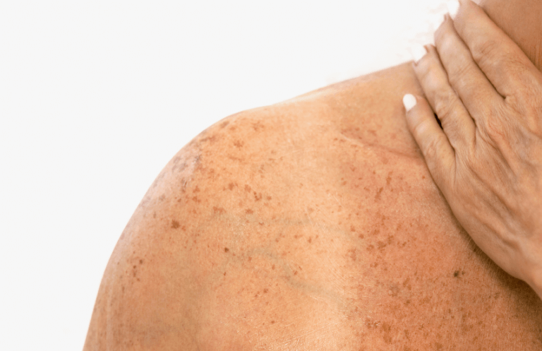 Pigmentation_v1