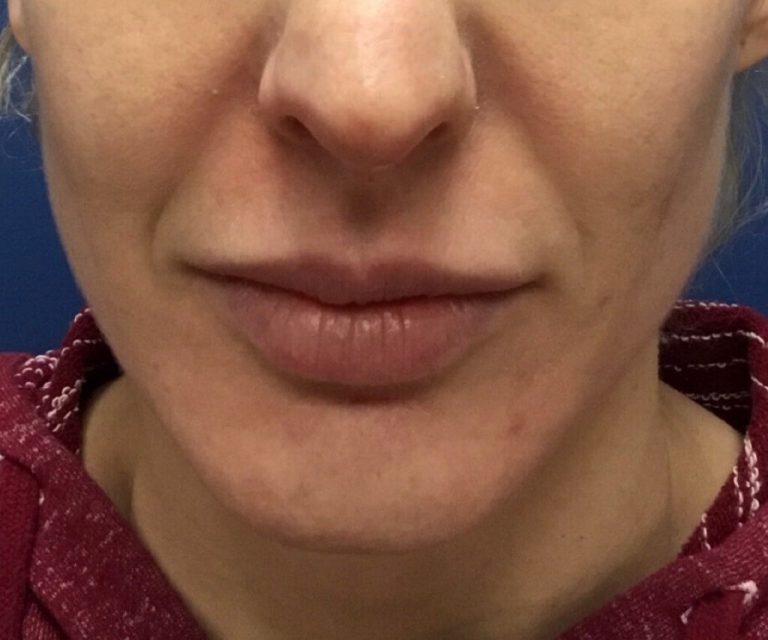 filler-b1