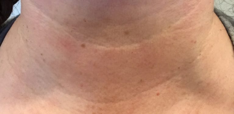 laser-treatment-a2