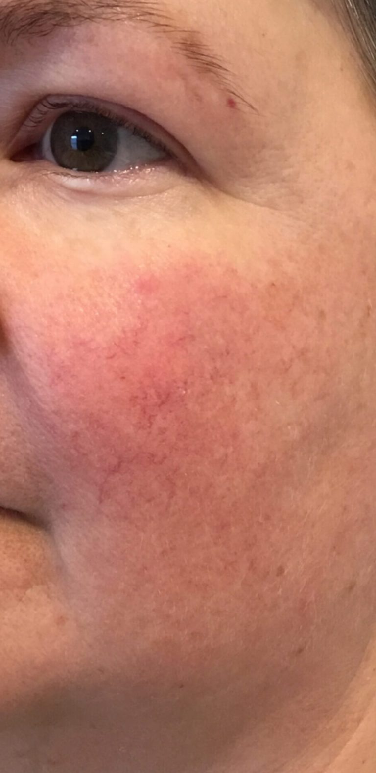 laser-treatment-a3