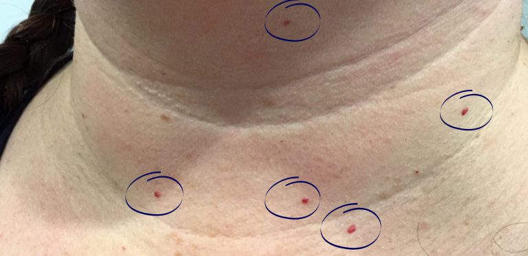 laser-treatment-b2