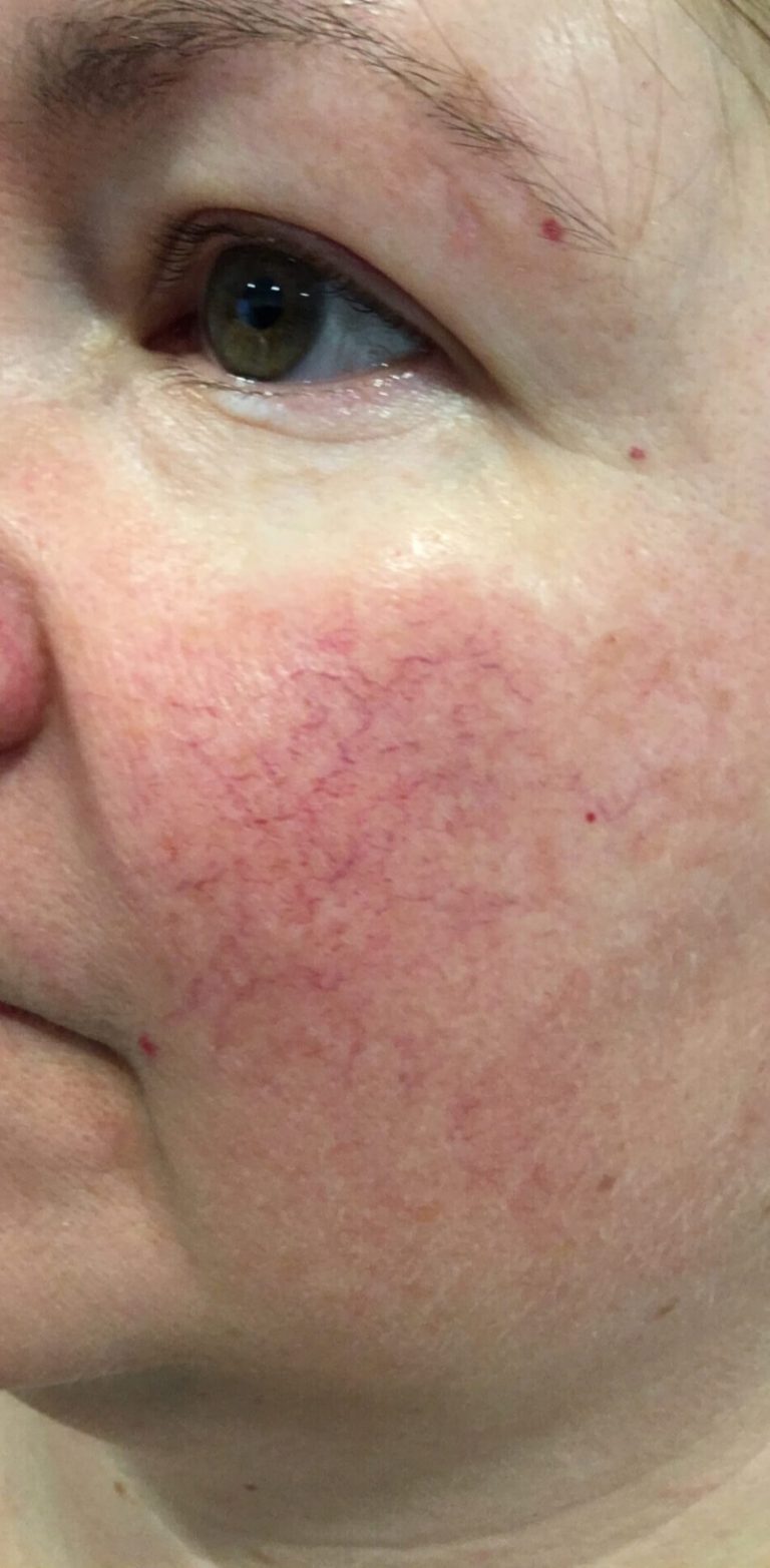 laser-treatment-b3